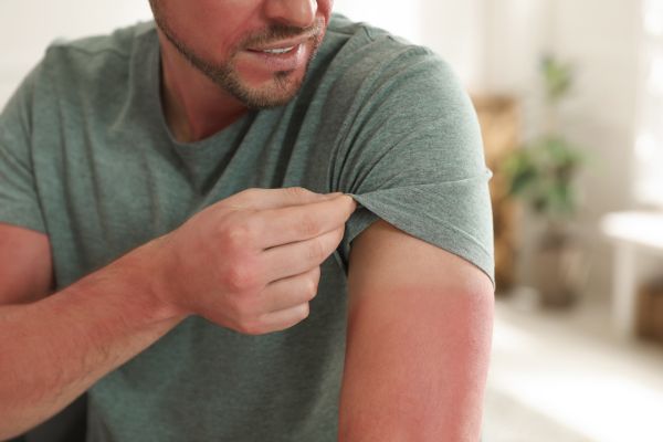 Sunburn: It's More Than Skin Deep